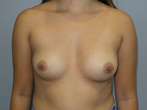 Breast Augmentation Before and After 95 | Sanjay Grover MD FACS