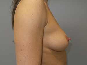 Breast Augmentation Before and After 43 | Sanjay Grover MD FACS