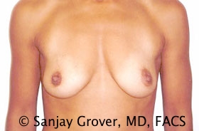 Breast Augmentation Before and After 207 | Sanjay Grover MD FACS