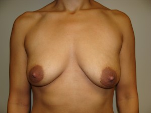 Breast Augmentation Before and After 27 | Sanjay Grover MD FACS