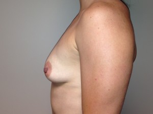 Breast Augmentation Before and After 51 | Sanjay Grover MD FACS