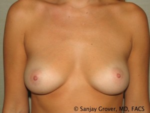 Breast Augmentation Before and After 305 | Sanjay Grover MD FACS