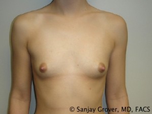 Breast Augmentation Before and After 188 | Sanjay Grover MD FACS