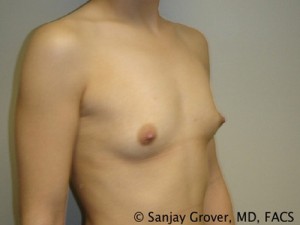 Breast Augmentation Before and After 61 | Sanjay Grover MD FACS