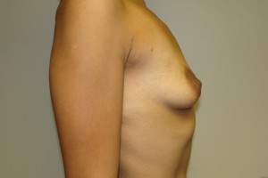 Breast Augmentation Before and After 61 | Sanjay Grover MD FACS