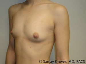 Breast Augmentation Before and After 61 | Sanjay Grover MD FACS