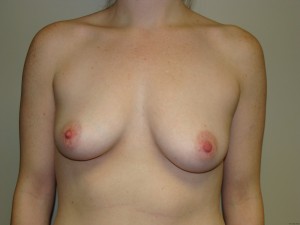 Breast Augmentation Before and After 279 | Sanjay Grover MD FACS