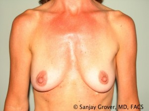Breast Augmentation Before and After 294 | Sanjay Grover MD FACS