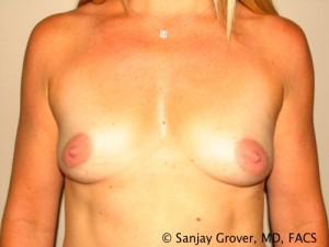 Breast Augmentation Before and After 264 | Sanjay Grover MD FACS