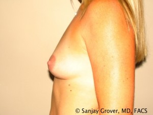 Breast Augmentation Before and After 75 | Sanjay Grover MD FACS