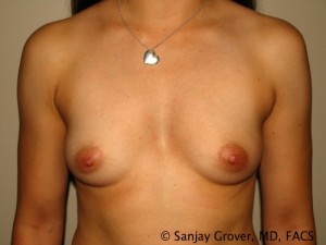 Breast Augmentation Before and After 96 | Sanjay Grover MD FACS