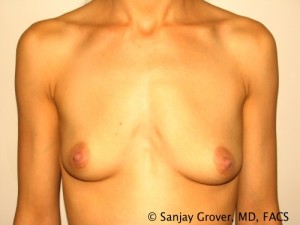 Breast Augmentation Before and After 26 | Sanjay Grover MD FACS