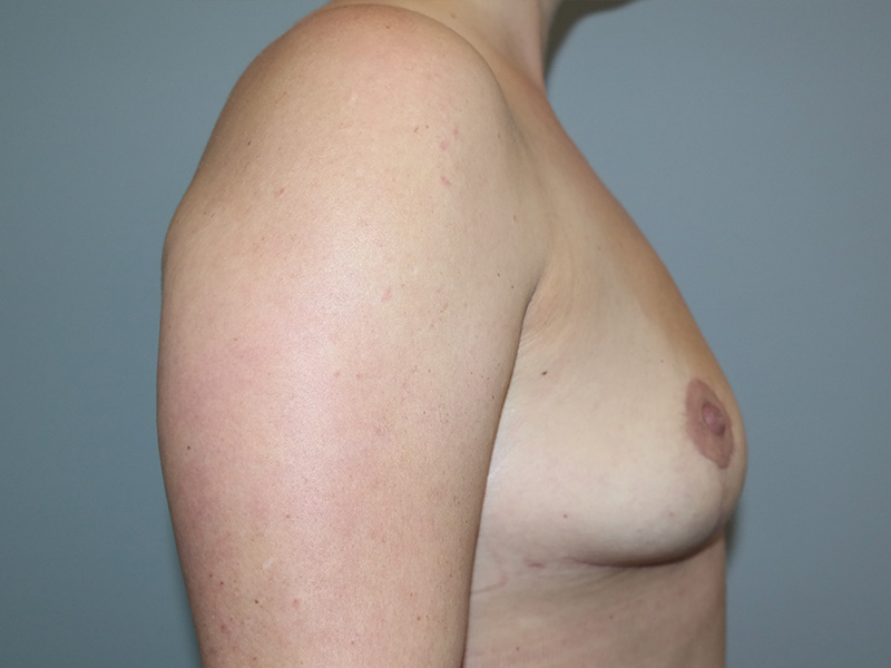 Breast Lift Before and After 04 | Sanjay Grover MD FACS