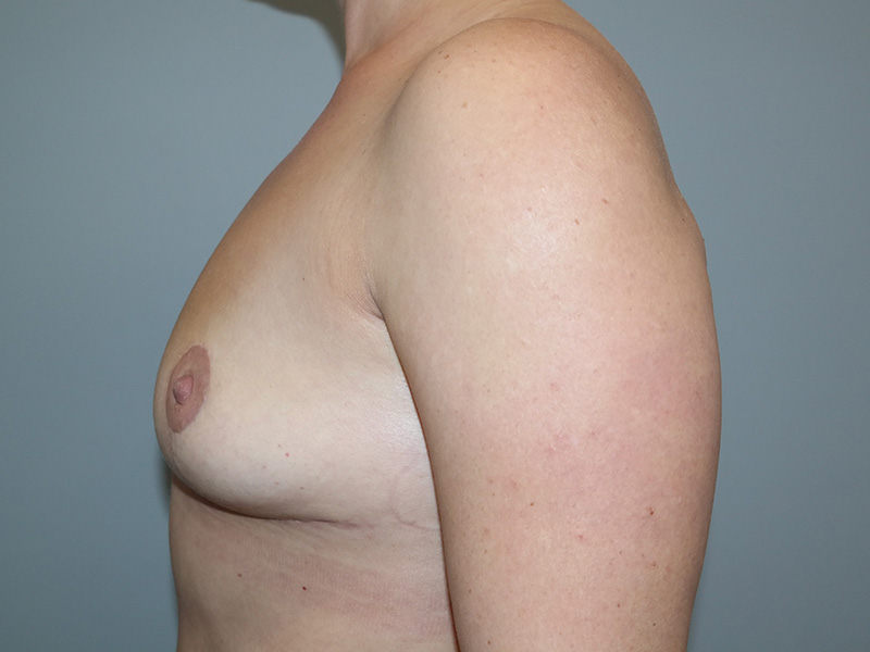 Breast Lift Before and After 04 | Sanjay Grover MD FACS