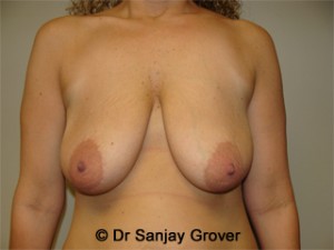 Breast Lift Before and After 38 | Sanjay Grover MD FACS