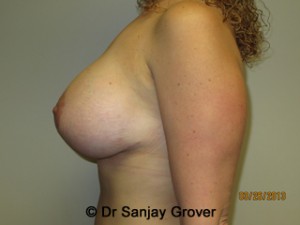 Breast Lift Before and After 09 | Sanjay Grover MD FACS