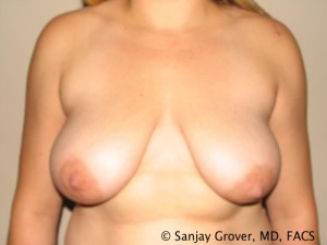 Breast Lift Before and After 01 | Sanjay Grover MD FACS