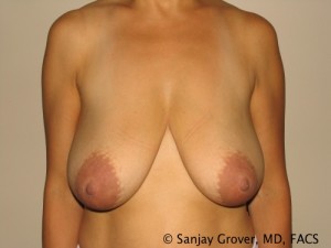 Breast Reduction Before and After 04 | Sanjay Grover MD FACS