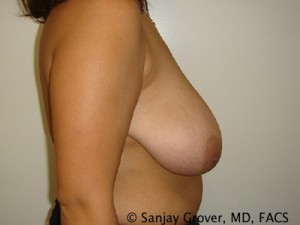 Breast Reduction Before and After 13 | Sanjay Grover MD FACS