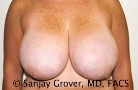 Breast Reduction Before and After 21 | Sanjay Grover MD FACS