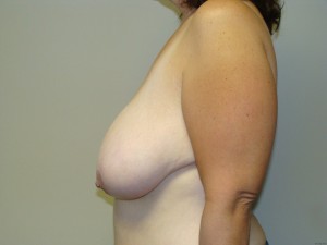 Breast Reduction Before and After 19 | Sanjay Grover MD FACS