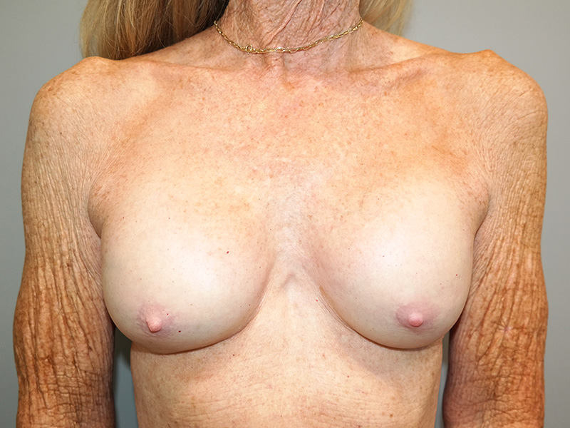 Breast Revision Before and After 39 | Sanjay Grover MD FACS