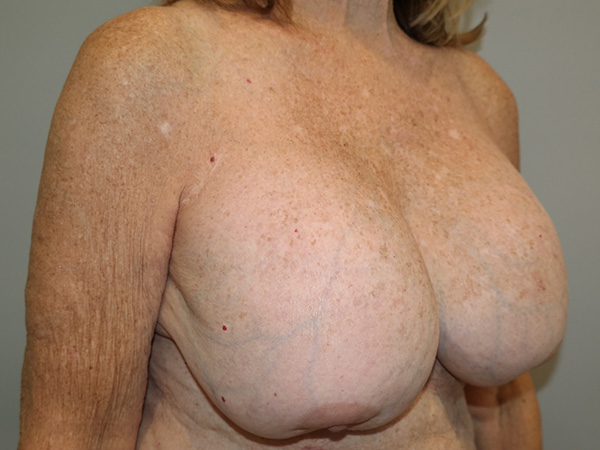 Breast Revision Before and After 07 | Sanjay Grover MD FACS