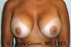 Breast Revision Before and After 19 | Sanjay Grover MD FACS