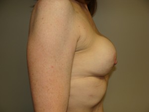 Breast Revision Before and After 22 | Sanjay Grover MD FACS