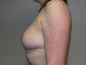 Breast Revision Before and After 22 | Sanjay Grover MD FACS