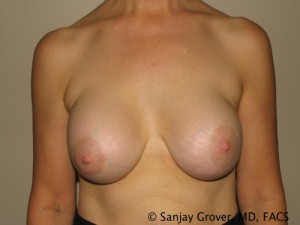 Breast Revision Before and After 60 | Sanjay Grover MD FACS