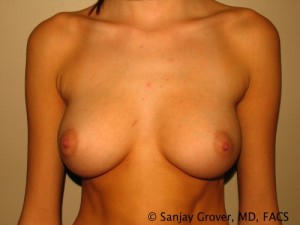 Breast Revision Before and After 54 | Sanjay Grover MD FACS