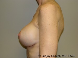 Breast Revision Before and After 29 | Sanjay Grover MD FACS