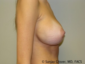 Breast Revision Before and After 30 | Sanjay Grover MD FACS