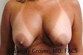 Breast Revision Before and After 40 | Sanjay Grover MD FACS
