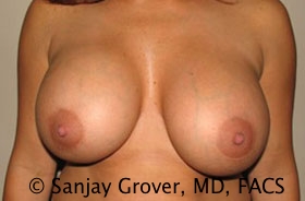 Breast Revision Before and After 07 | Sanjay Grover MD FACS
