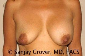 Breast Revision Before and After 56 | Sanjay Grover MD FACS
