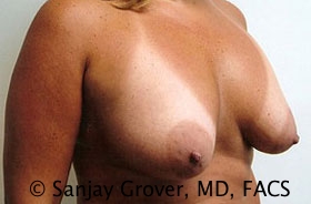 Breast Revision Before and After 35 | Sanjay Grover MD FACS