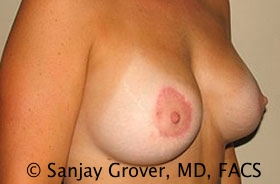 Breast Revision Before and After 35 | Sanjay Grover MD FACS