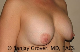 Breast Revision Before and After 36 | Sanjay Grover MD FACS