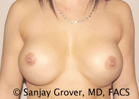 Breast Revision Before and After 58 | Sanjay Grover MD FACS