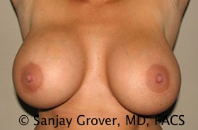 Breast Revision Before and After 37 | Sanjay Grover MD FACS