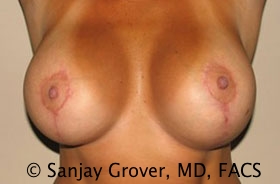 Breast Revision Before and After 37 | Sanjay Grover MD FACS