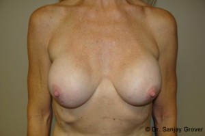 Breast Revision Before and After 55 | Sanjay Grover MD FACS
