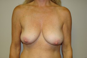 Breast Revision Before and After 48 | Sanjay Grover MD FACS