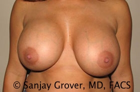 Breast Revision Before and After 21 | Sanjay Grover MD FACS