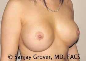 Breast Revision Before and After 46 | Sanjay Grover MD FACS