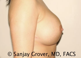 Breast Revision Before and After 47 | Sanjay Grover MD FACS