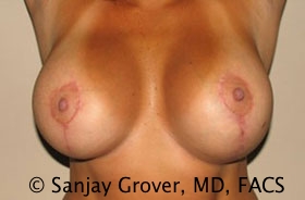 Breast Revision Before and After 48 | Sanjay Grover MD FACS