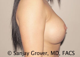 Breast Revision Before and After 48 | Sanjay Grover MD FACS